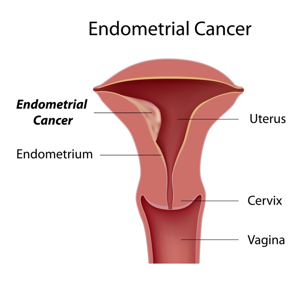 tumore endometrio